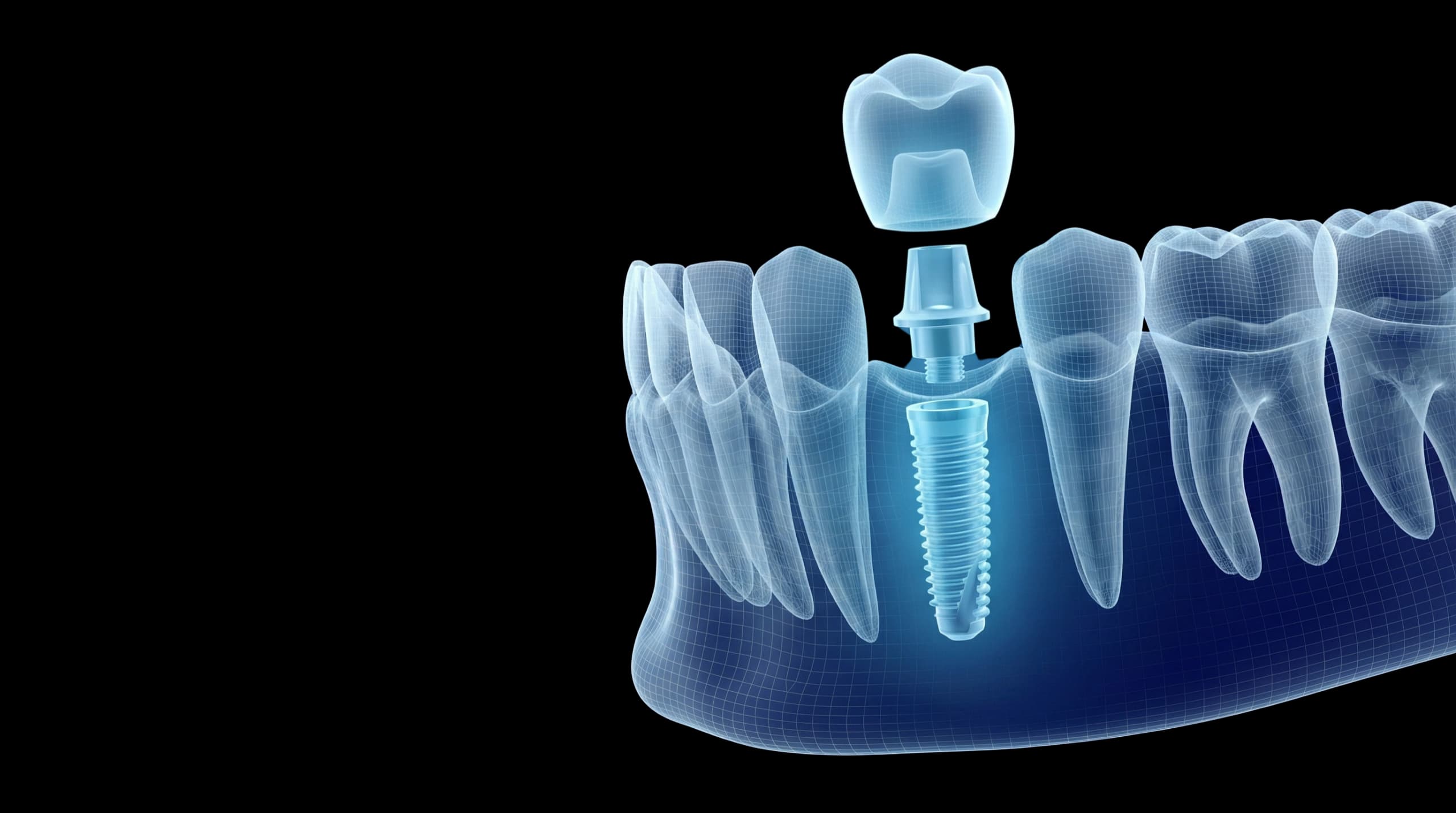 Dental Implants